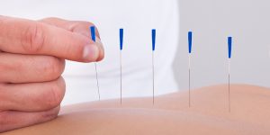 Akupunktur gegen Unfruchtbarkeit