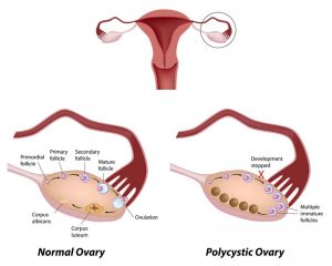 PCOS Fruchtbarkeit und Diät