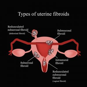 Uterine Fibroids and Their Role on Infertility