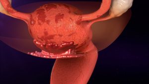 Die Auswirkungen von Endometriose auf die Qualität der Eizellen