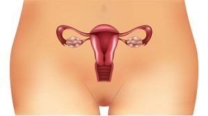 Ovarialzysten (Eierstockzysten) und ihre Auswirkung auf die Fruchtbarkeit