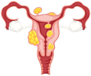 Gebärmutterfehlbildungsbedingte Unfruchtbarkeit: wie Anomalien Ihre Fruchtbarkeit beeinträchtigen können 1