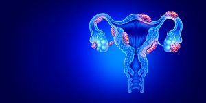 Das ist ein Endometrios