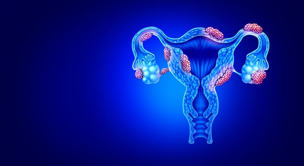 Neue Behandlungsansätze im Kampf gegen Endometriose