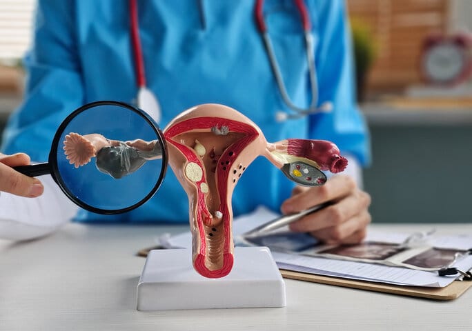Verbesserte PCOS-Symptome korrelieren mit der Zusammensetzung der Darmbakterien